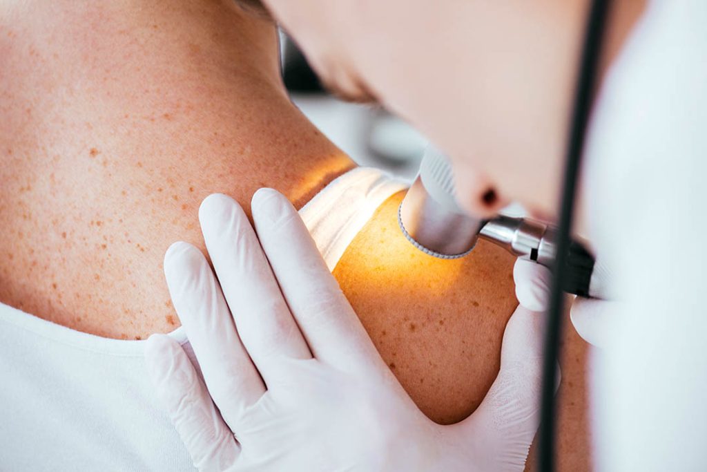 Dietary Fibre Improves Response to Melanoma Treatment