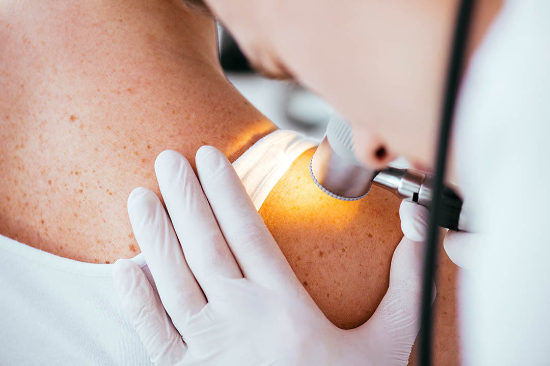 examining woman with melanoma